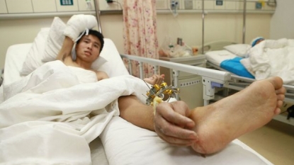 Medical Miracles: Doctors stitched the severed hand to leg to keep it alive