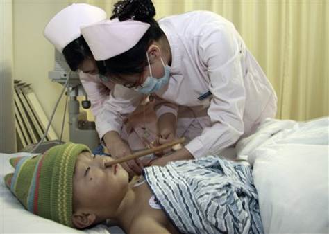Two year old survived miraculously after a chopstick pierced into his brain