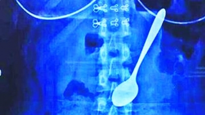 Doctors removed the spoon from the girls stomach, which she accidentally swallowed while eating ice-cream